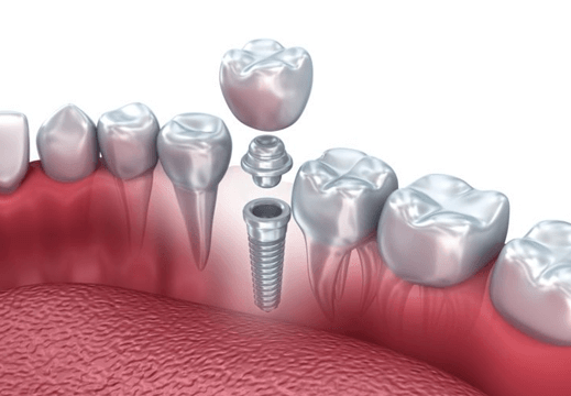 İstanbul’da En İyi Implant Merkezi