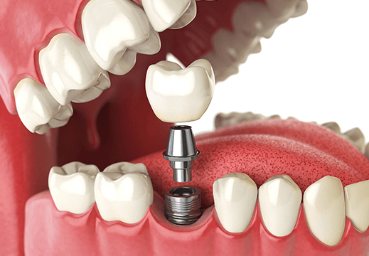 Başarısız Implant Çözümü
